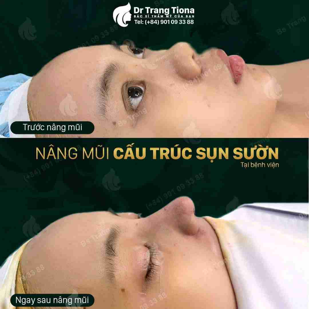 Nâng mũi sụn sườn – Xu hướng thẩm mỹ mũi năm 2023