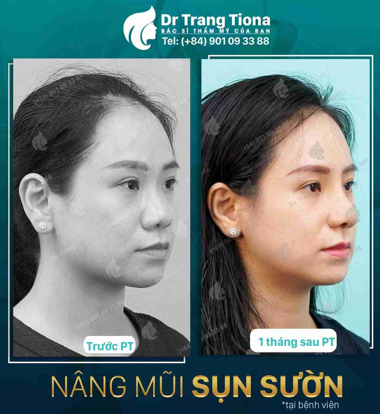 Nâng mũi sụn sườn – Xu hướng thẩm mỹ mũi năm 2023
