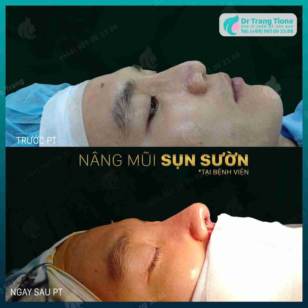 Nâng mũi sụn sườn – Xu hướng thẩm mỹ mũi năm 2023