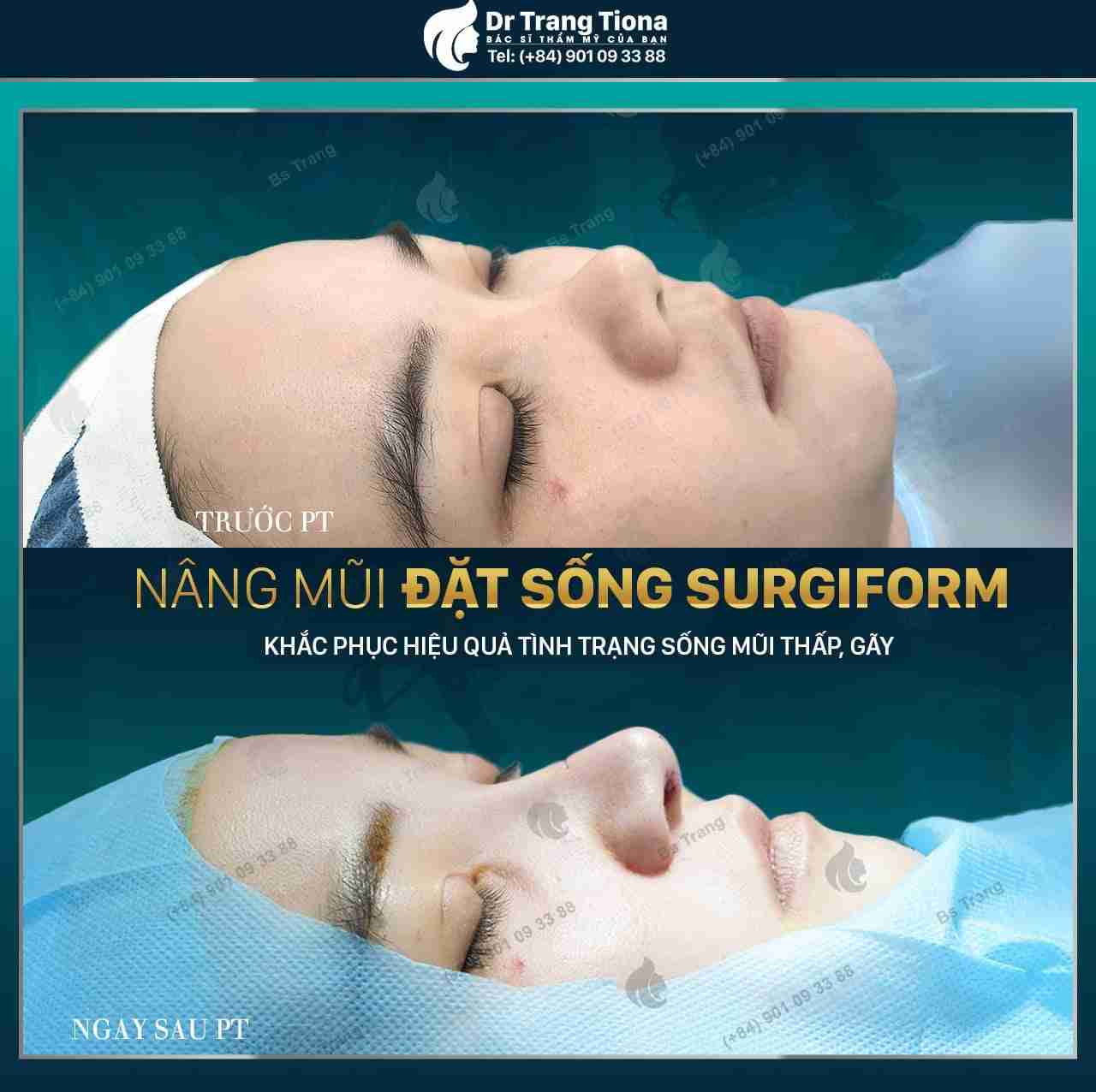 Nâng mũi sống Surgiform là gì? Nâng mũi sống Surgiform có tốt không?