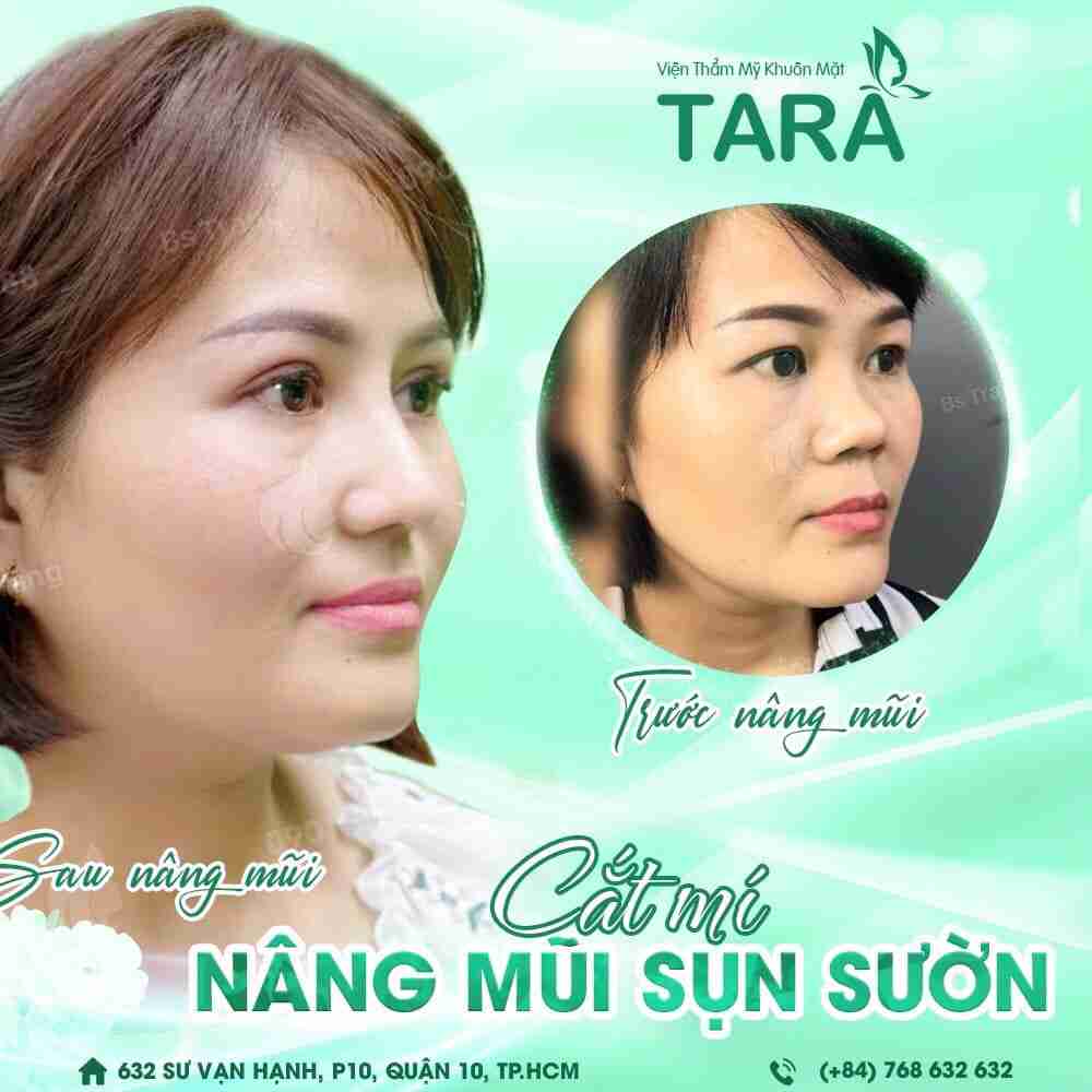 Nâng mũi sụn tự thân hay sụn nhân tạo thì đẹp nhất?