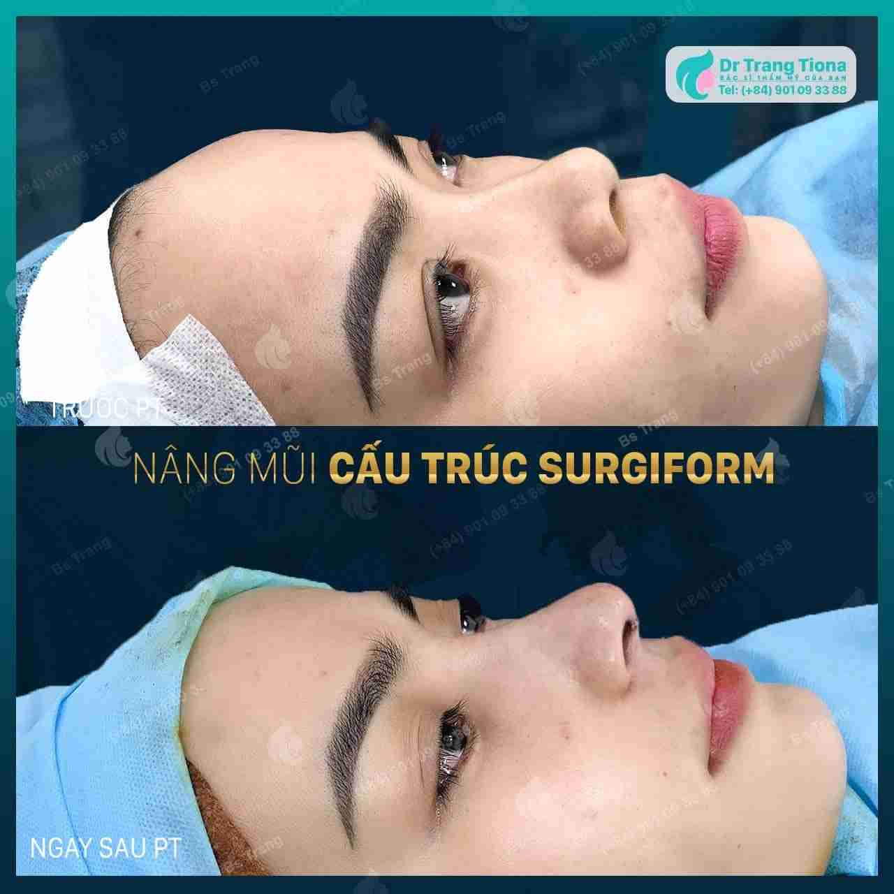 Nâng mũi Surgiform là gì? Có bị co rút không?