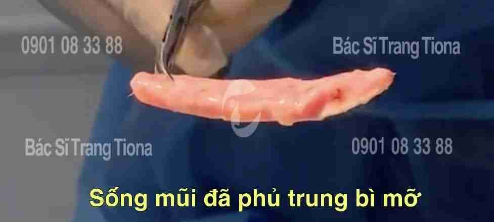 Nâng mũi trung bì mỡ giá bao nhiêu? Có đắt không?