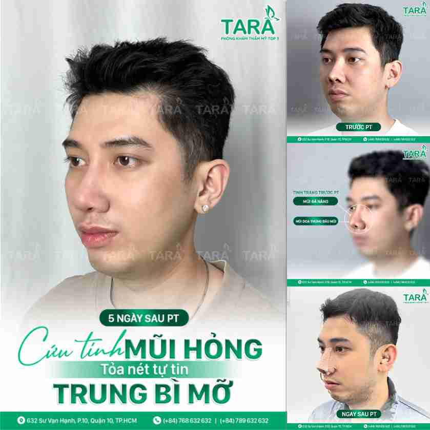 Nâng mũi trung bì mỡ là gì? Được thực hiện như nào?