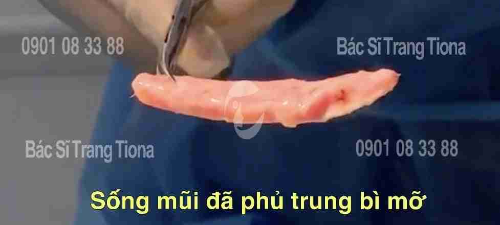 Nâng mũi trung bì mỡ là gì? Được thực hiện như nào?