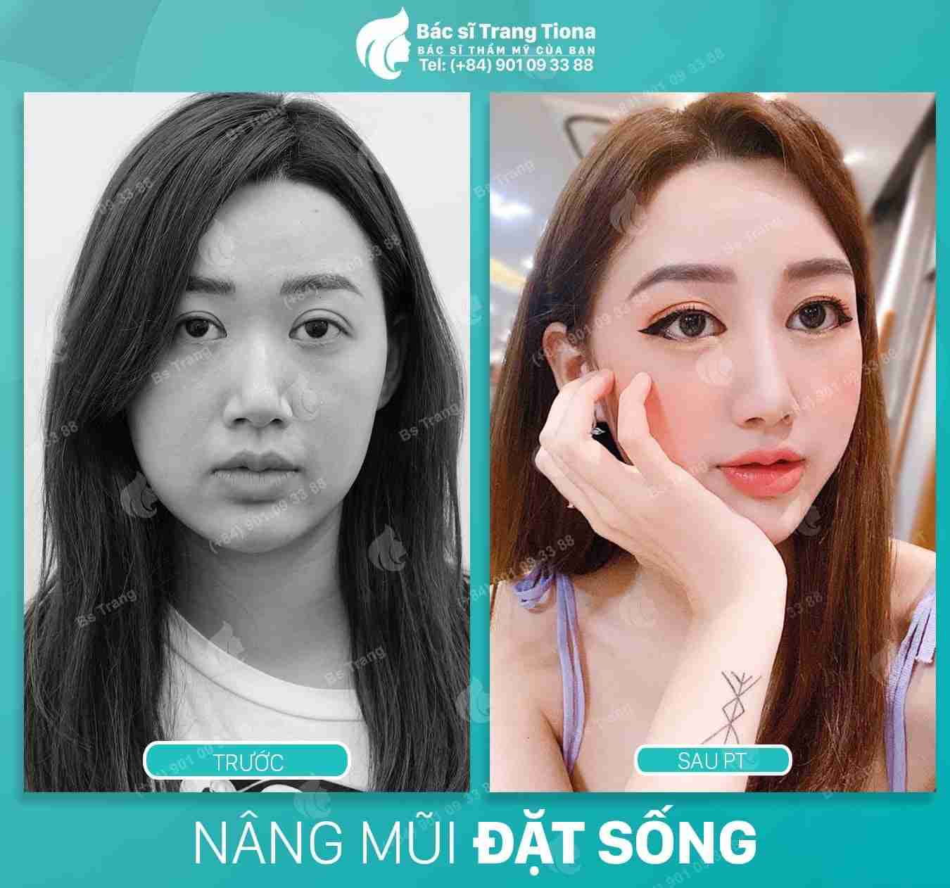 Nâng mũi xong có để lại di chứng về sau không?