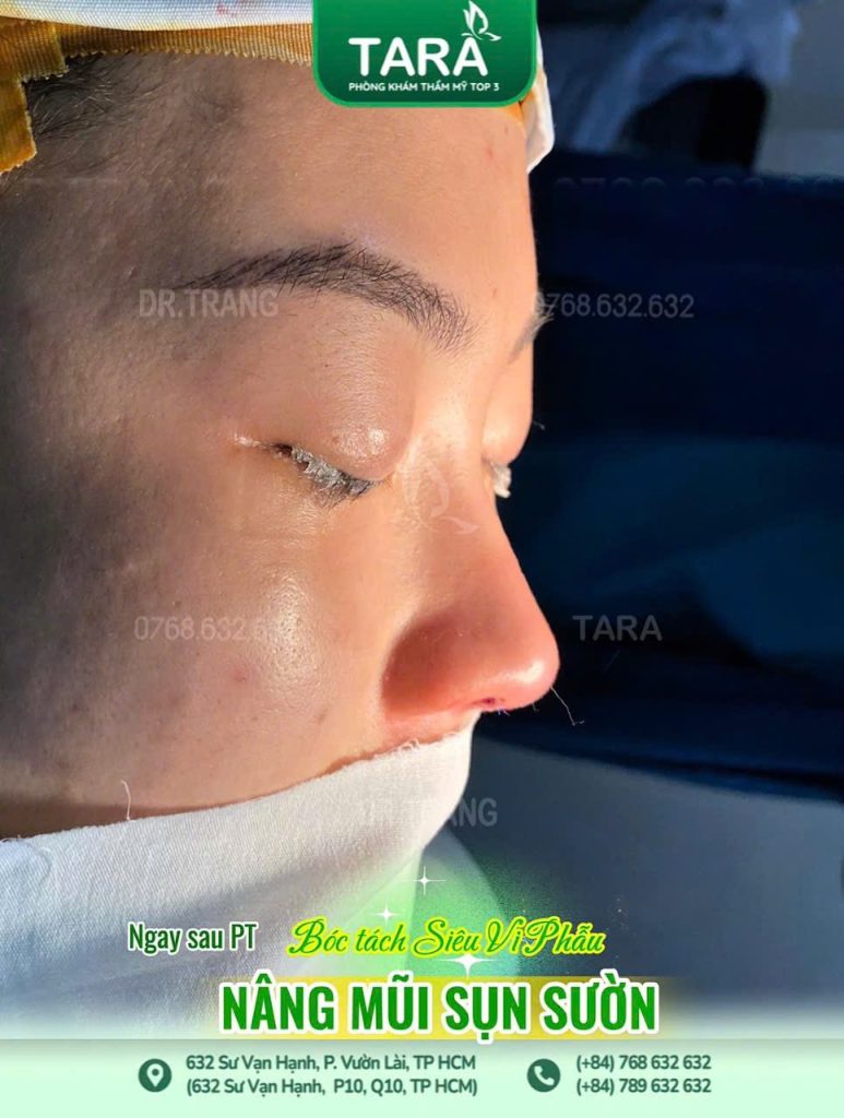 Bác sĩ giải đáp: Nâng mũi xong có tháo sụn ra ngay được không?