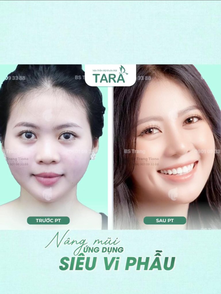 Bác sĩ giải đáp: Nâng mũi xong có tháo sụn ra ngay được không?
