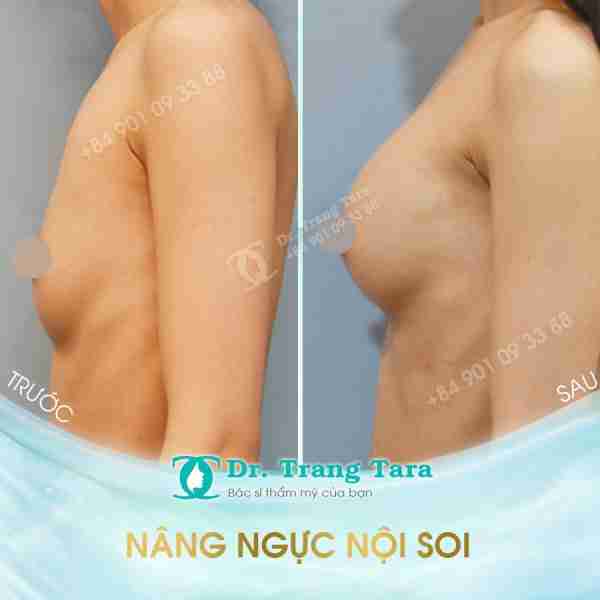 Nâng ngực bằng túi Nano Chip hiện đại | Bí quyết sở hữu vòng 1 quyến rũ