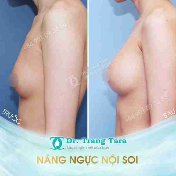 Nâng ngực bằng túi Nano Chip hiện đại | Bí quyết sở hữu vòng 1 quyến rũ