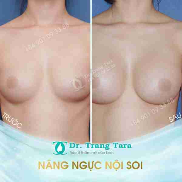 Nâng ngực bằng túi Nano Chip hiện đại | Bí quyết sở hữu vòng 1 quyến rũ
