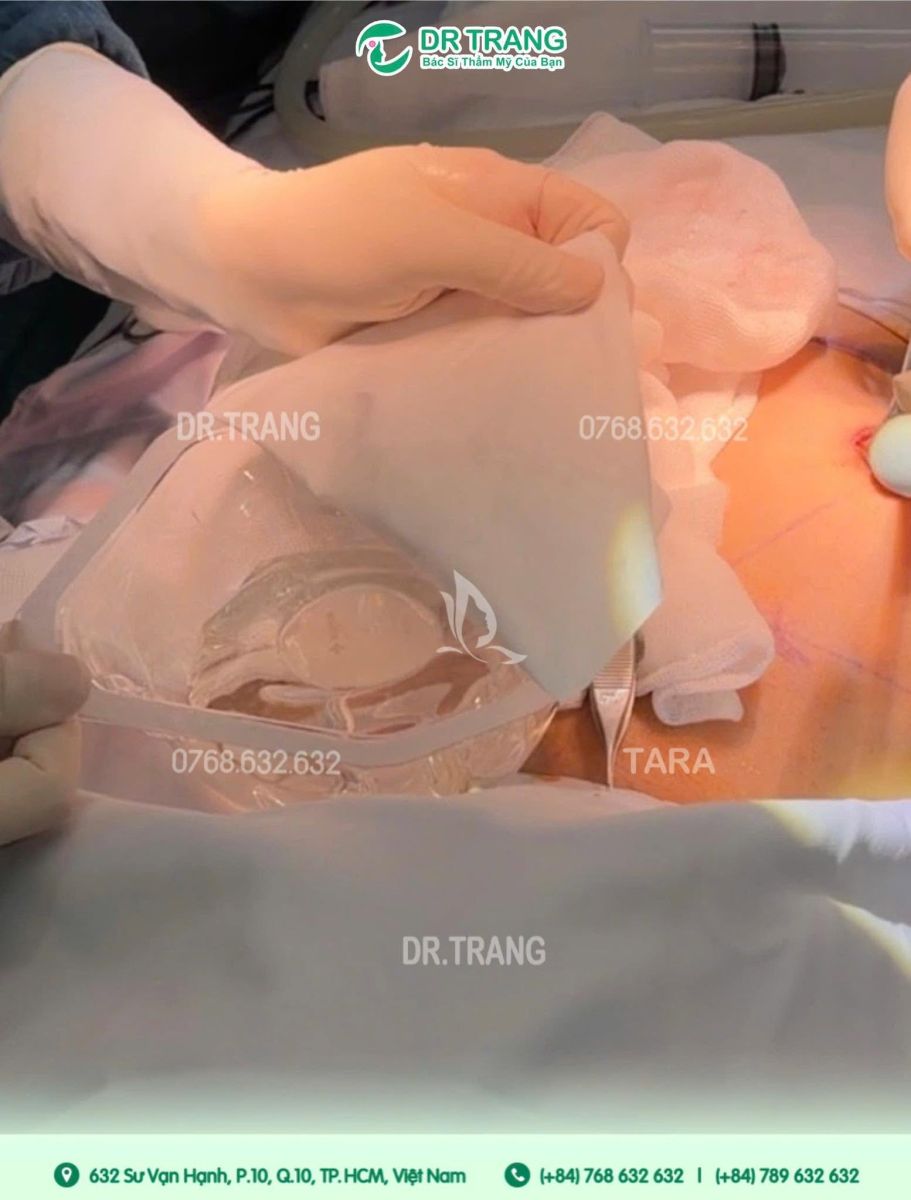 Nâng Ngực Bảo Tồn Mô Ngực Omega Preservé - Sự Lựa Chọn Cho Vẻ Đẹp Tự Nhiên