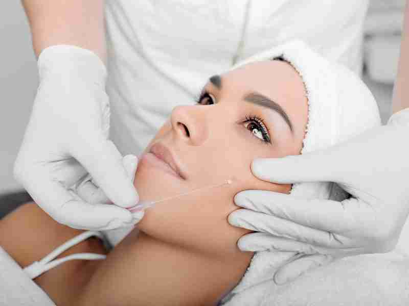 Nên căng da mặt bằng chỉ hay phẫu thuật căng da Midface