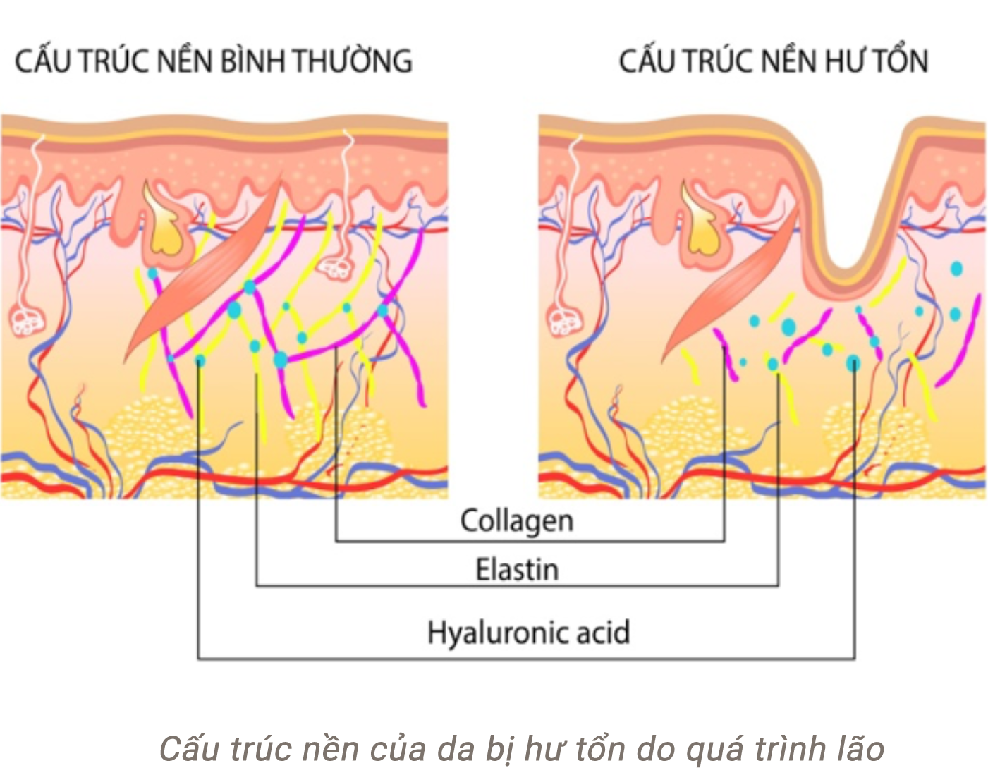 Nên căng da mặt hay cấy mỡ mặt điều trị lão hóa thì tốt nhất?