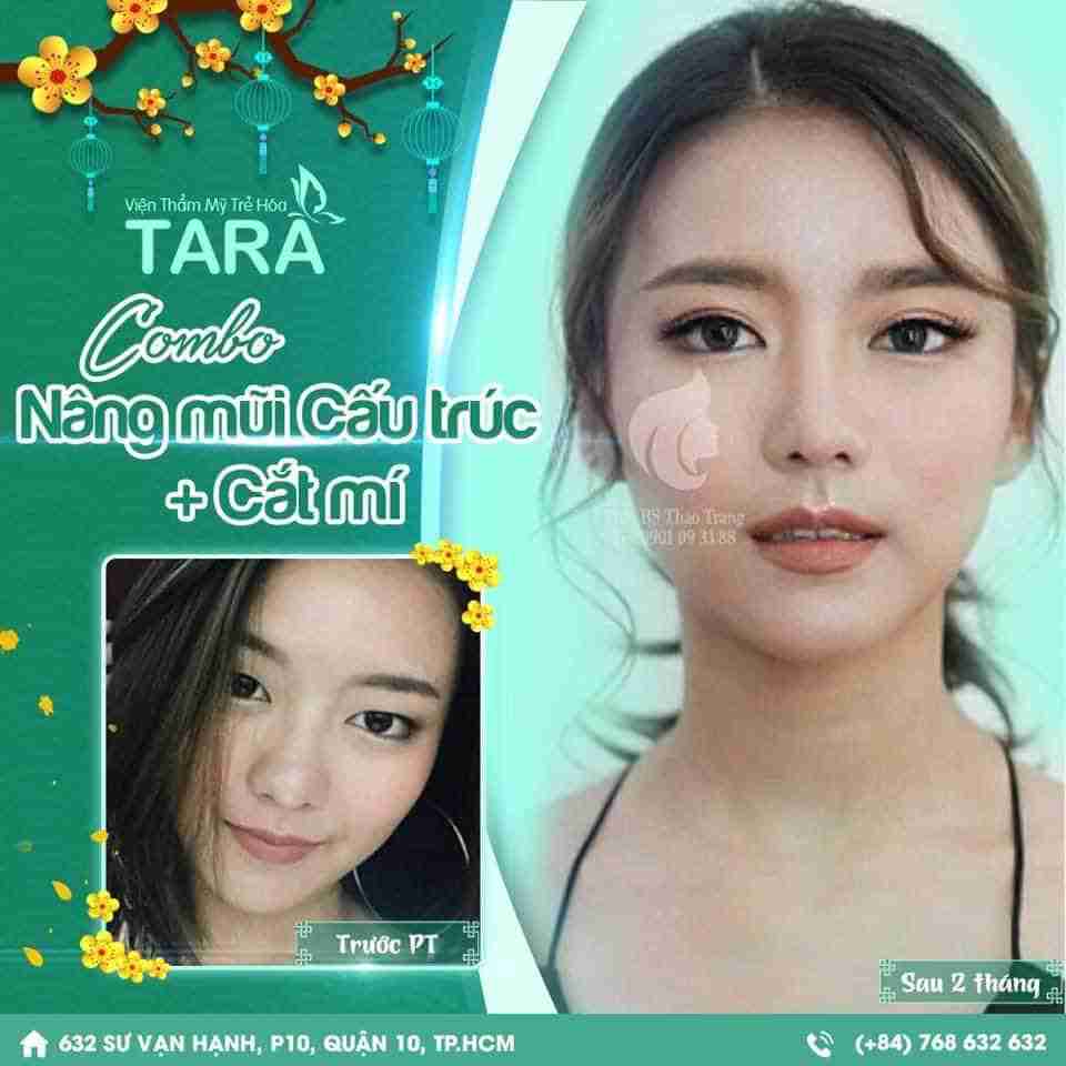 Nên cắt mí hay nhấn mí mắt thì tốt hơn?