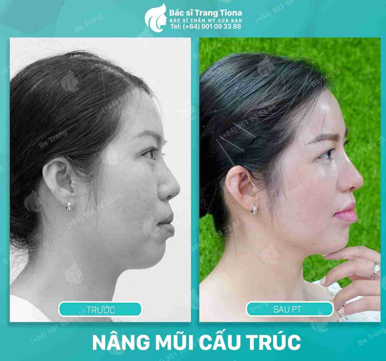 Nên niềng răng trước hay sau khi nâng mũi?