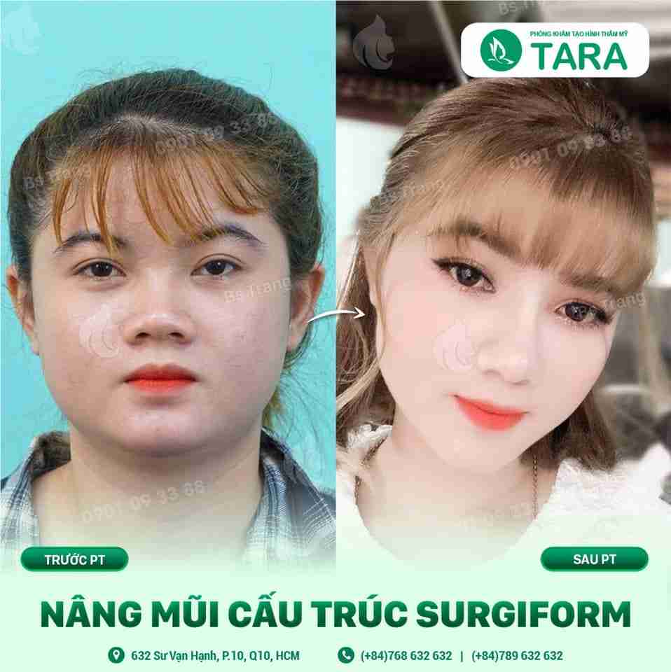 Nguyên nhân gây ra đầu mũi to mà bạn chưa biết