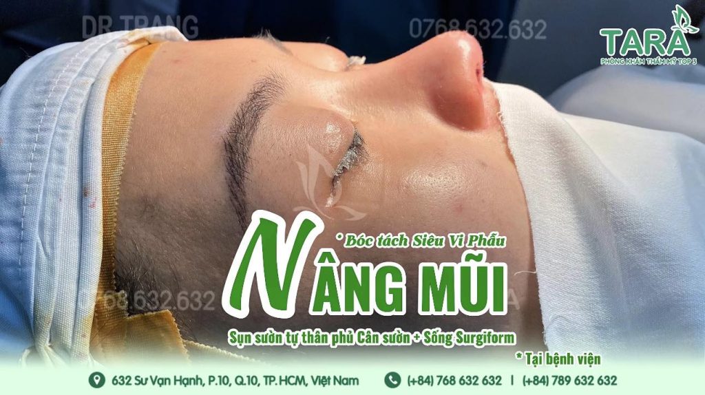 Nhật ký hồi phục sau nâng mũi siêu vi phẫu