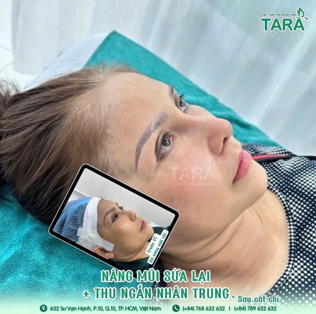 Những ai nên và không nên nâng mũi siêu vi phẫu?