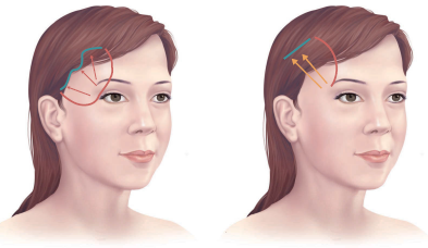 Căng da thái dương: 5 lưu ý – 5 biến chứng thường gặp