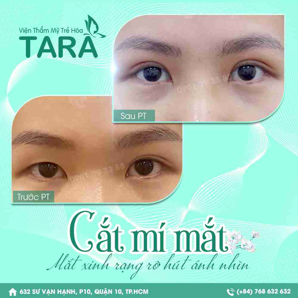 Nỗi lo cắt mí mắt ảnh hưởng đến thị lực: Đúng hay sai?