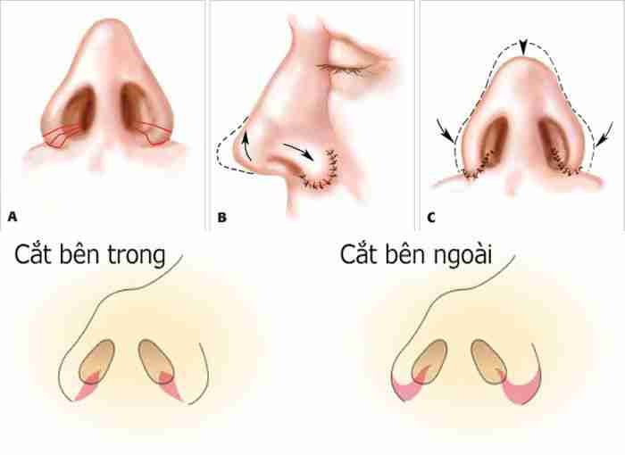 Hiểu rõ về phương pháp cuộn cánh mũi và cắt cánh mũi