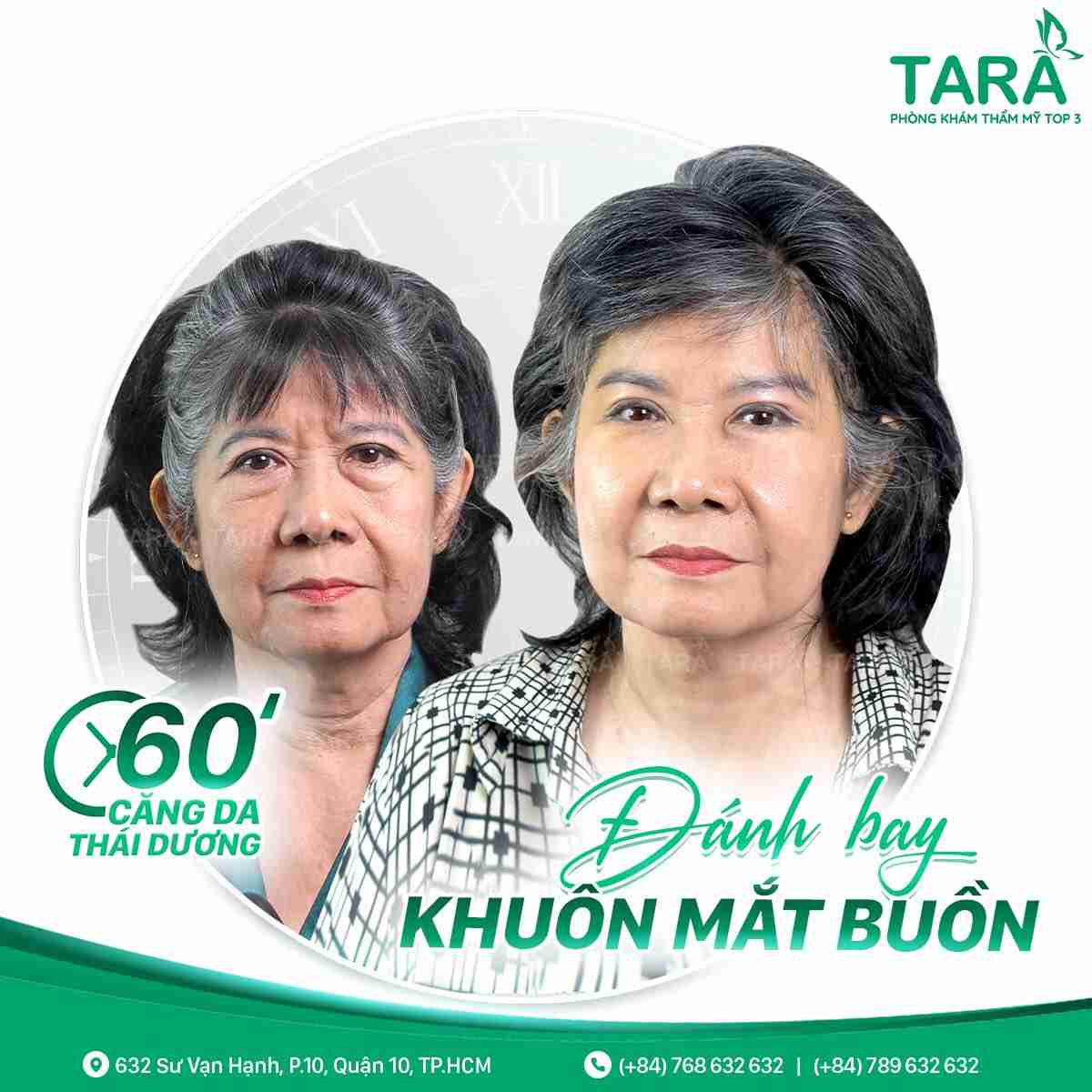 Bí quyết phẫu thuật căng da mặt đẹp nhất 2024
