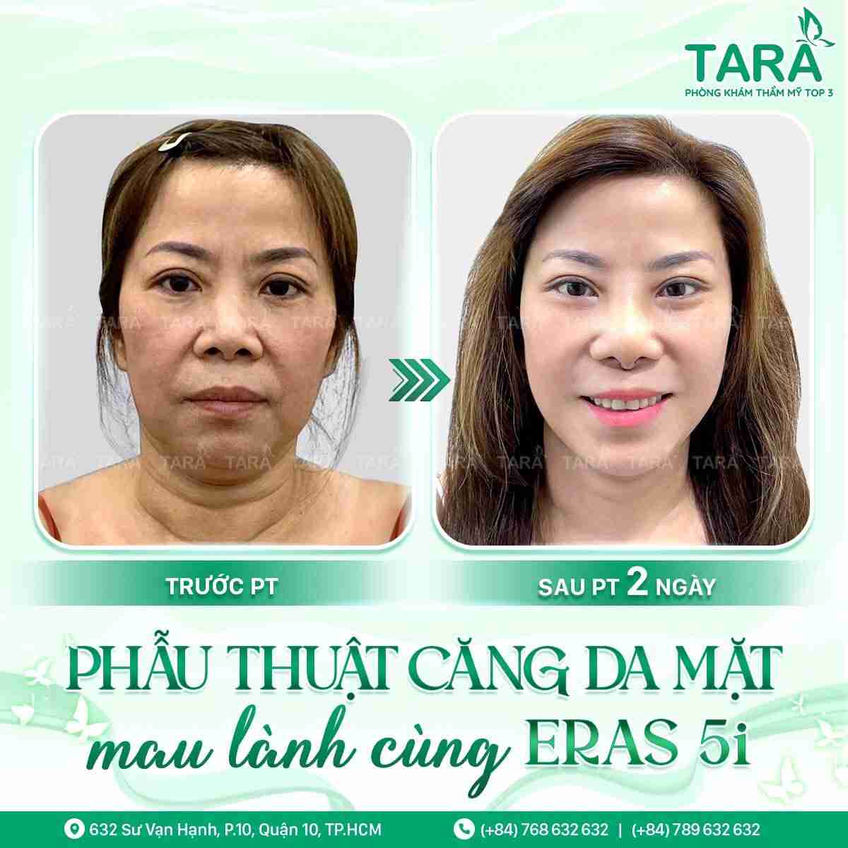 Bí quyết phẫu thuật căng da mặt đẹp nhất 2024