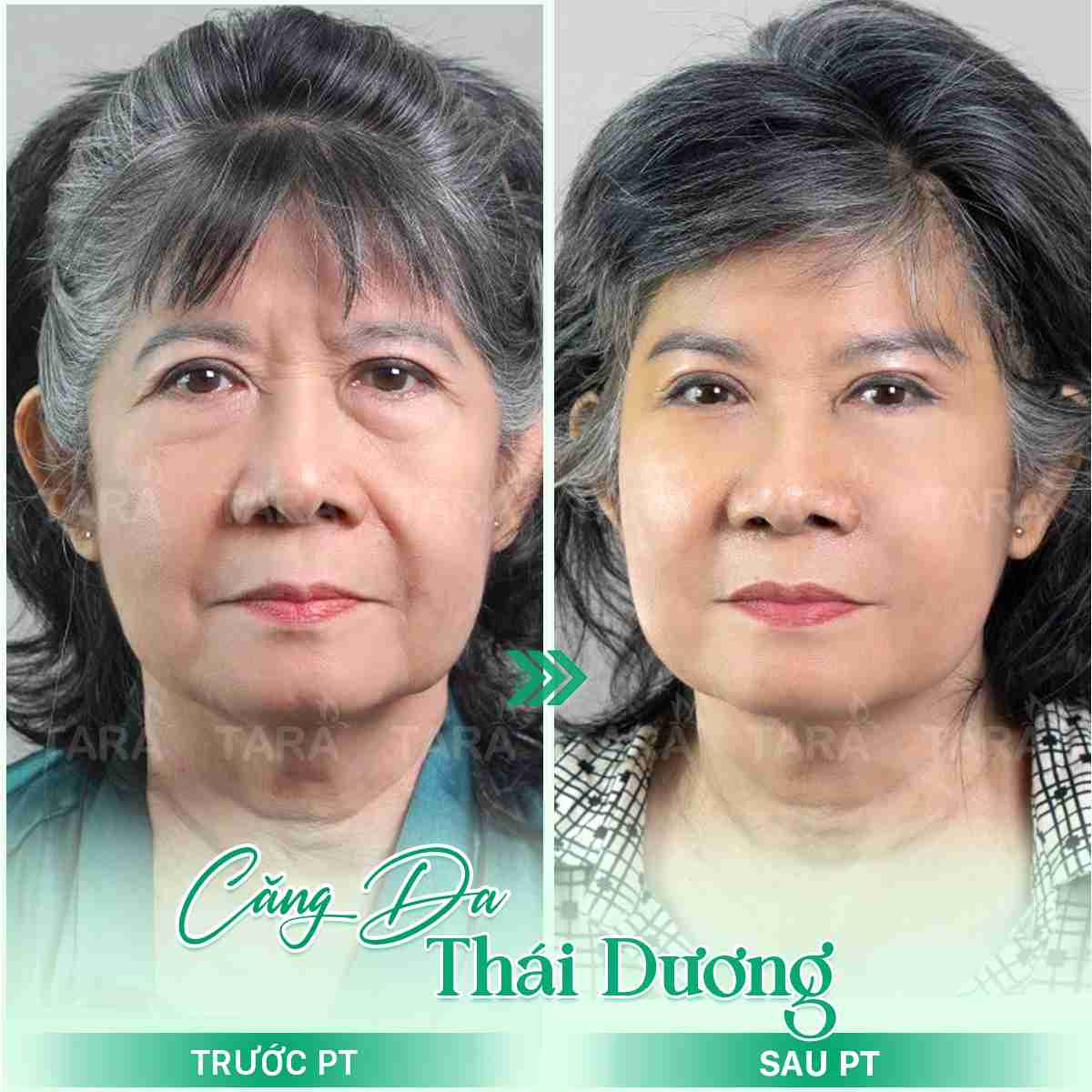 Bí quyết phẫu thuật căng da mặt đẹp nhất 2024