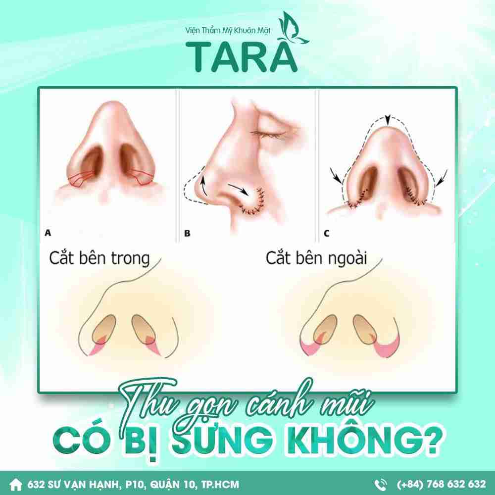 Phẫu thuật cắt cánh mũi là gì? Thực hiện như thế nào?