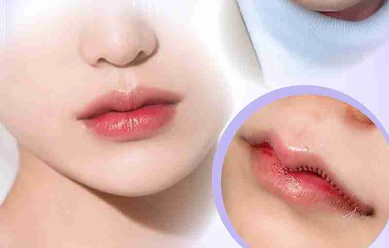 Trọn bộ phẫu thuât môi trái tim chuẩn Y khoa