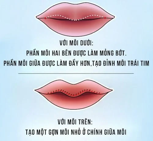 Trọn bộ phẫu thuât môi trái tim chuẩn Y khoa