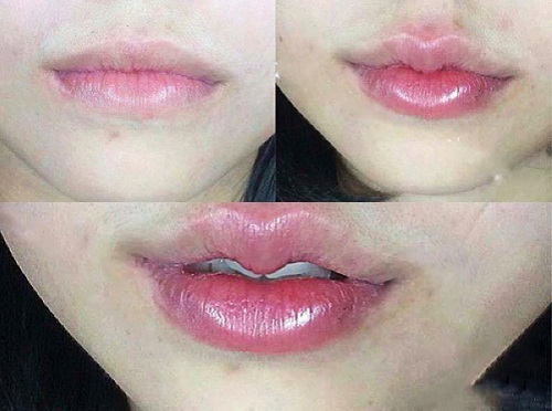 Phẫu thuật môi trái tim có để lại sẹo không và lưu ý quan trọng