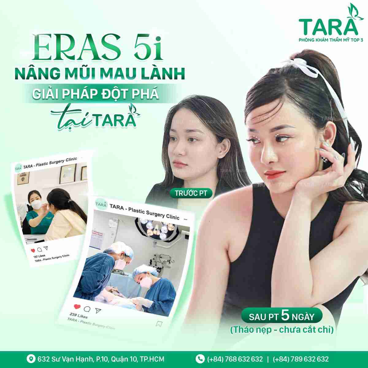 Nâng mũi sống Surgiform là gì? Nâng mũi sống Surgiform có tốt không?
