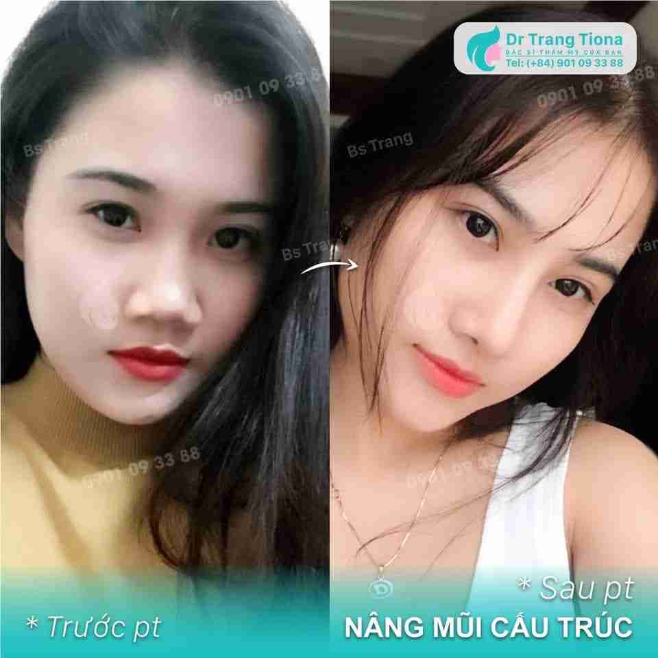 Phẫu thuật sửa mũi hếch như thế nào? Có đắt không?