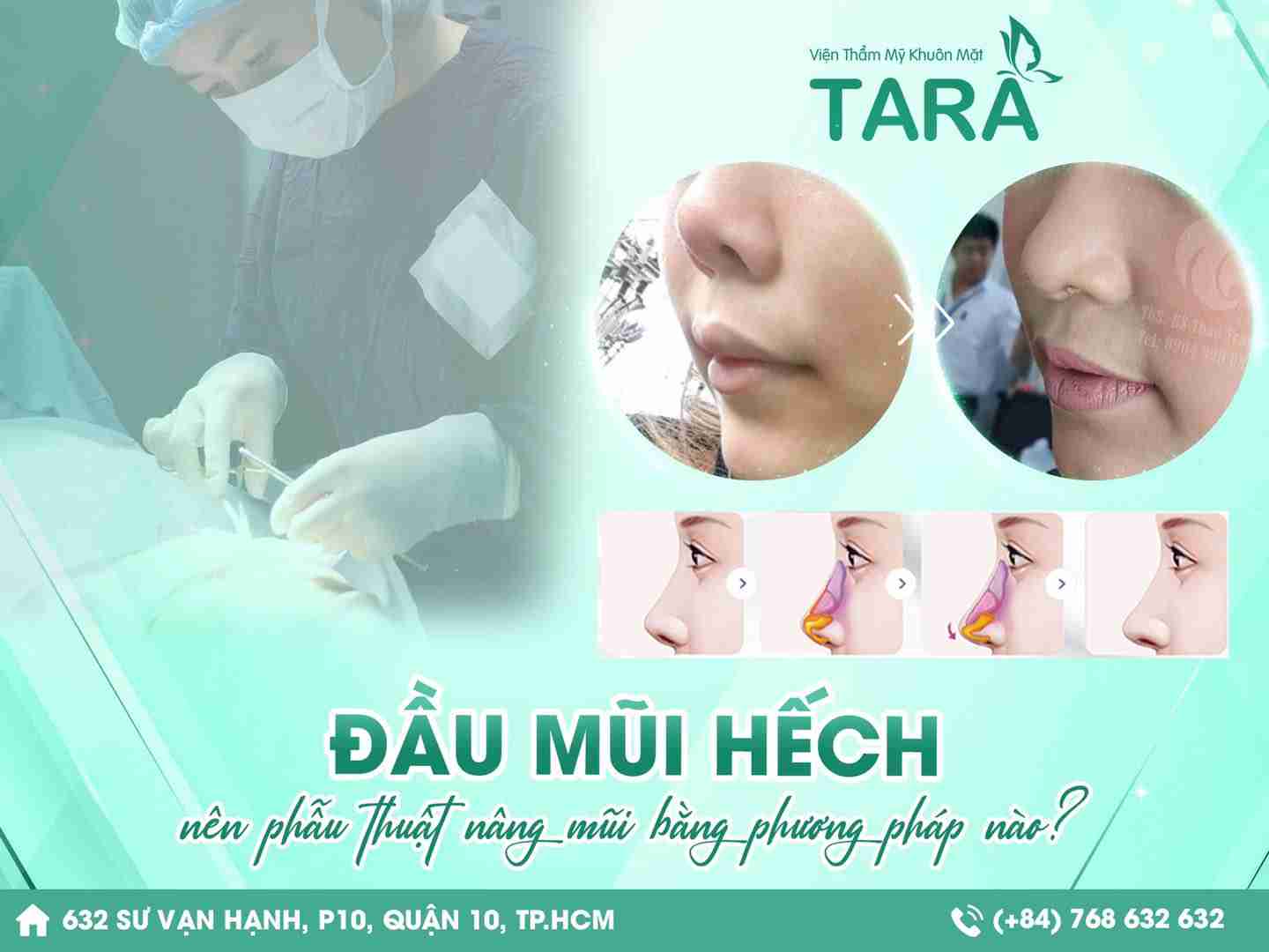 Phẫu thuật sửa mũi hếch như thế nào? Có đắt không?
