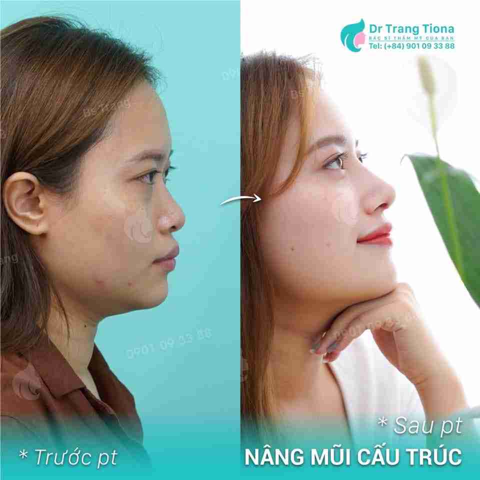 Phẫu thuật sửa mũi hếch như thế nào? Có đắt không?
