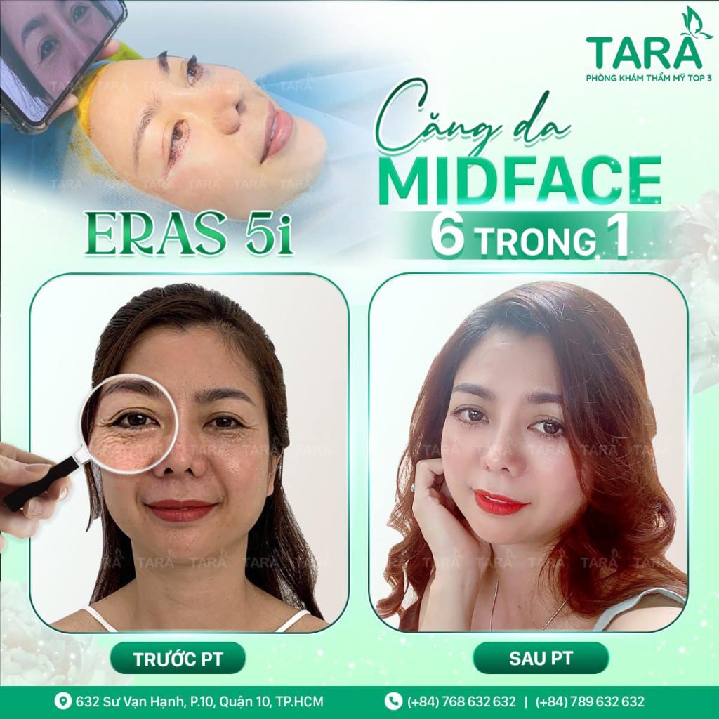 Phục hồi sau phẫu thuật căng da Midface và những điều cần lưu ý