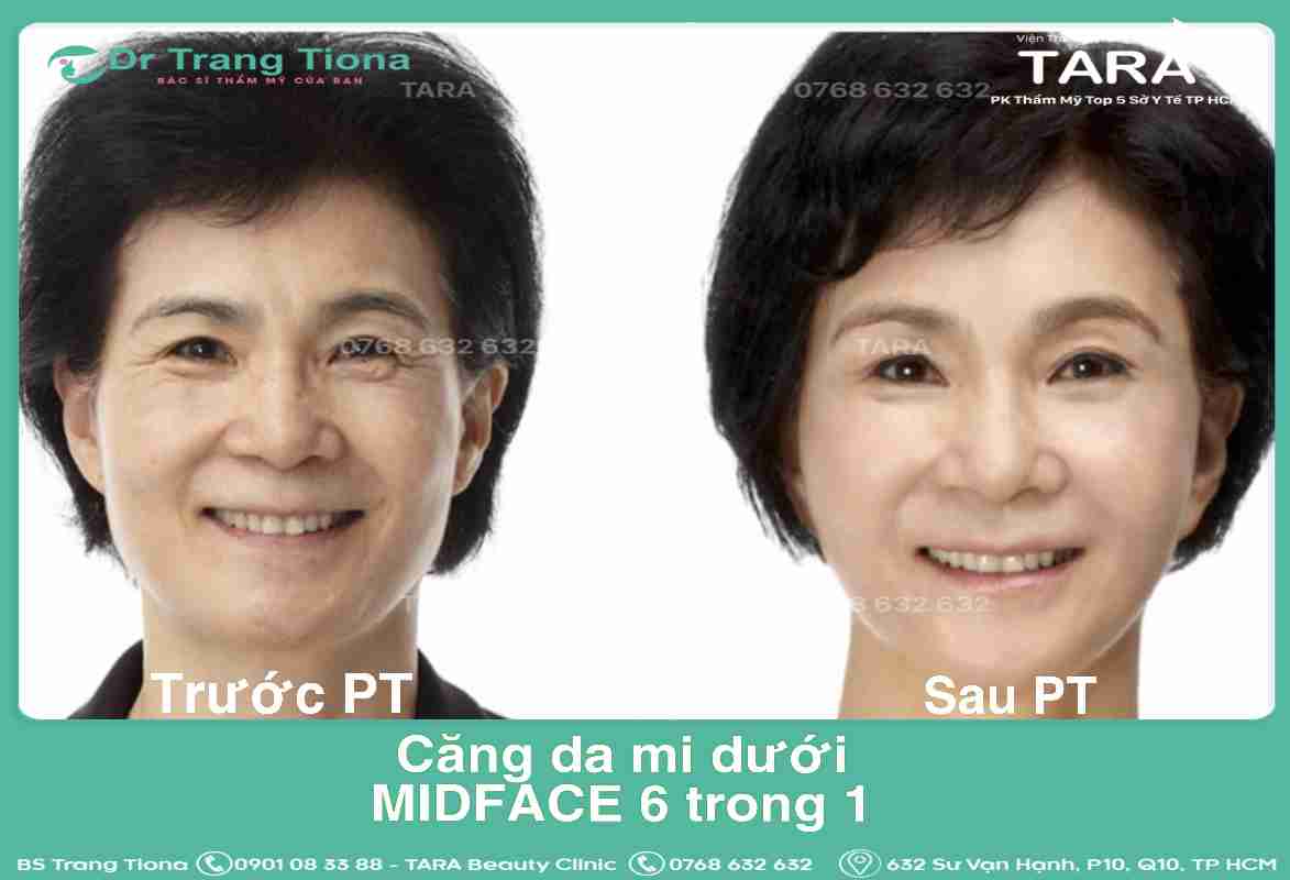 Đâu là phương pháp xóa nhăn đuôi mắt hiệu quả?