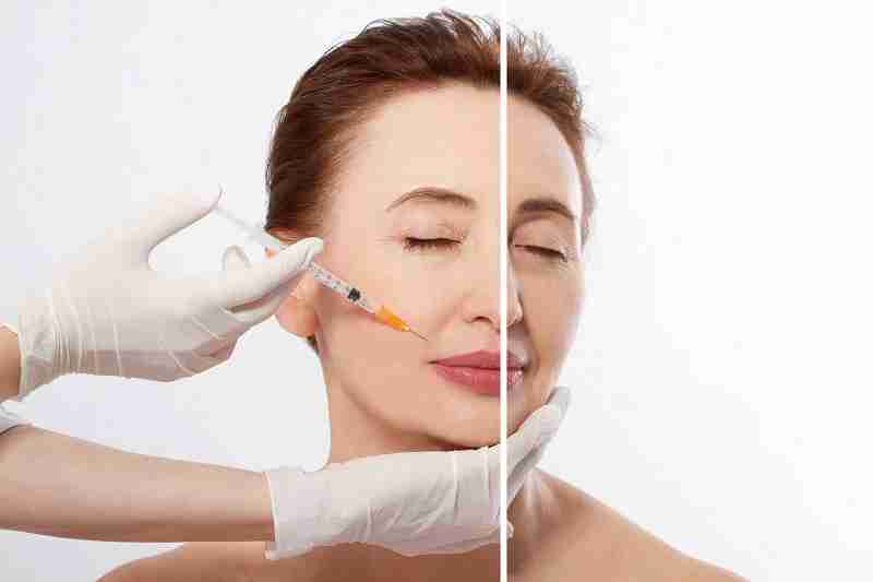 Cách xóa rãnh cười râu rồng hiệu quả hiện nay