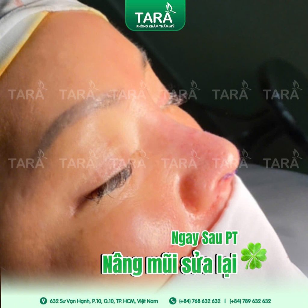 Quy trình sửa mũi hỏng bằng kỹ thuật siêu vi phẫu chuẩn Y khoa