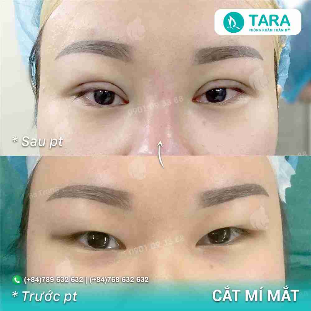 Review chi tiết cắt mắt hai mí bền đẹp tự nhiên