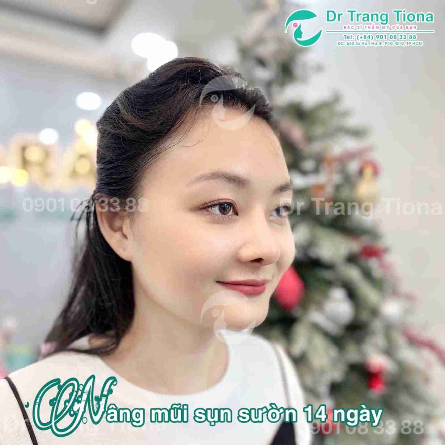 Review nâng mũi sụn sườn: Không phải ai cũng phù hợp