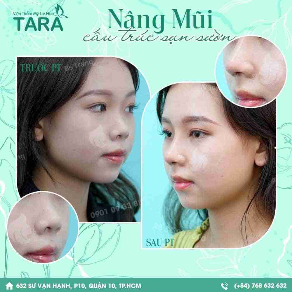 Review nâng mũi sụn sườn: Không phải ai cũng phù hợp