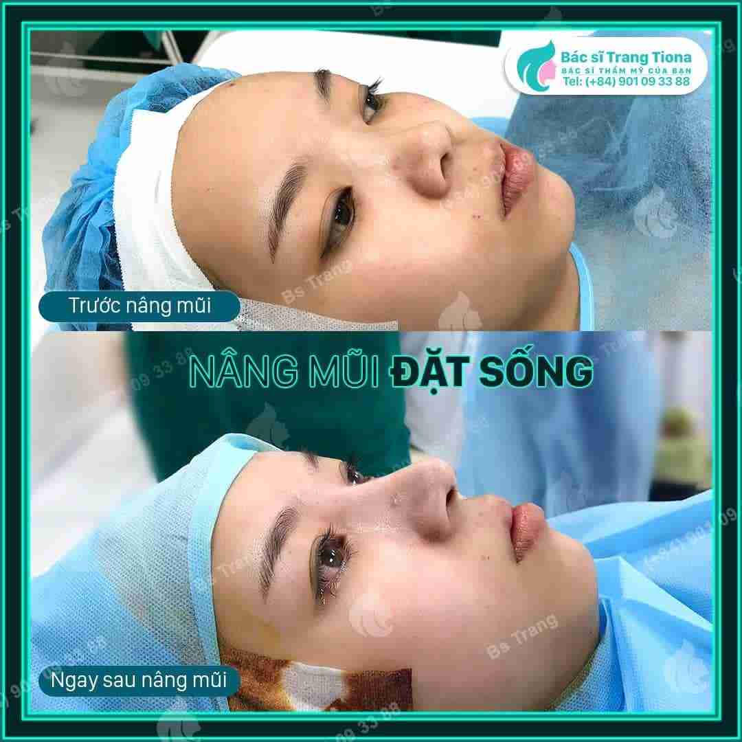 Sau bao lâu thì được sờ nắn bóp mũi sau nâng?