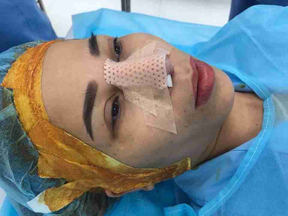 Sau bao lâu thì được tháo nẹp khi nâng mũi sụn sườn?