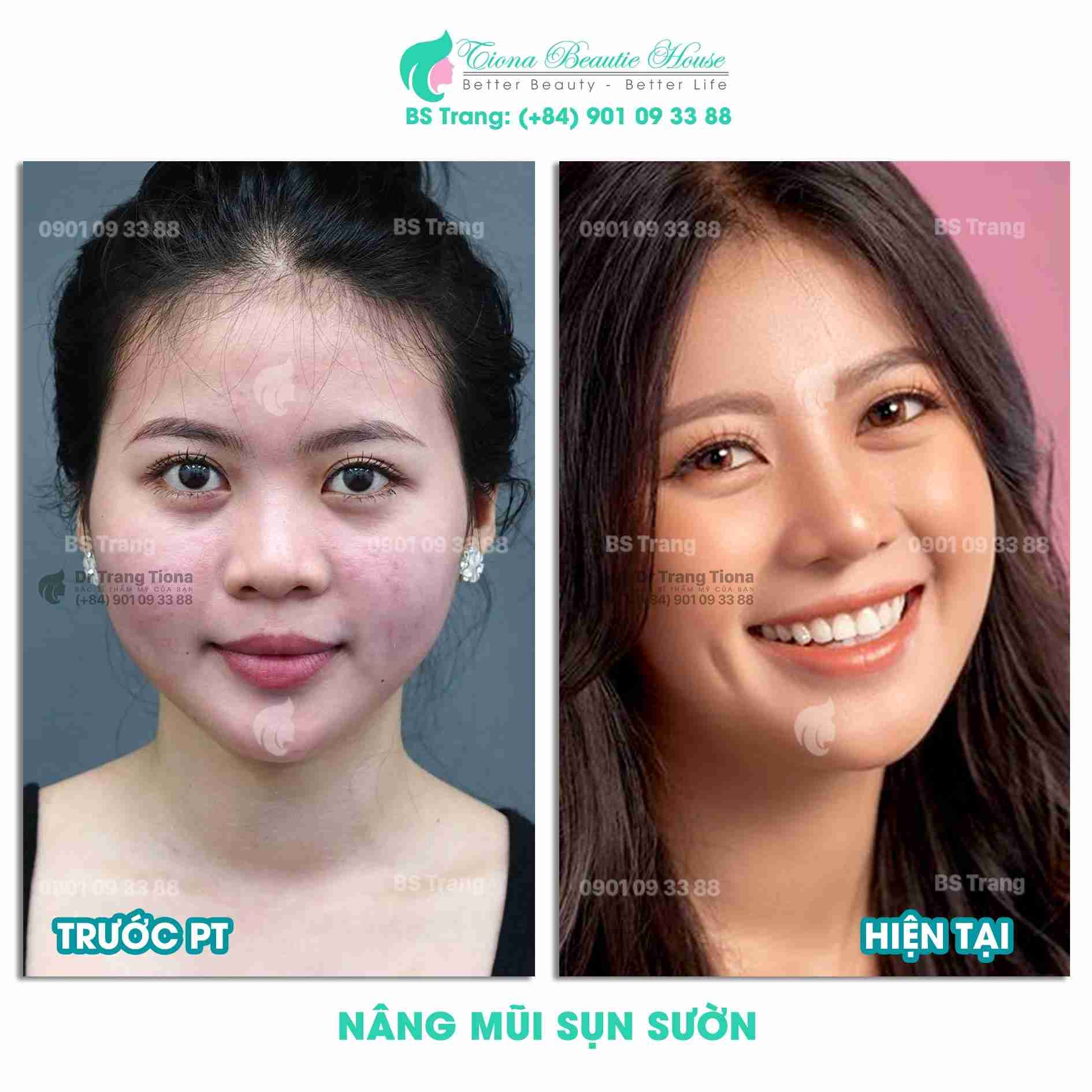 Sau bao lâu thì được tháo nẹp khi nâng mũi sụn sườn?