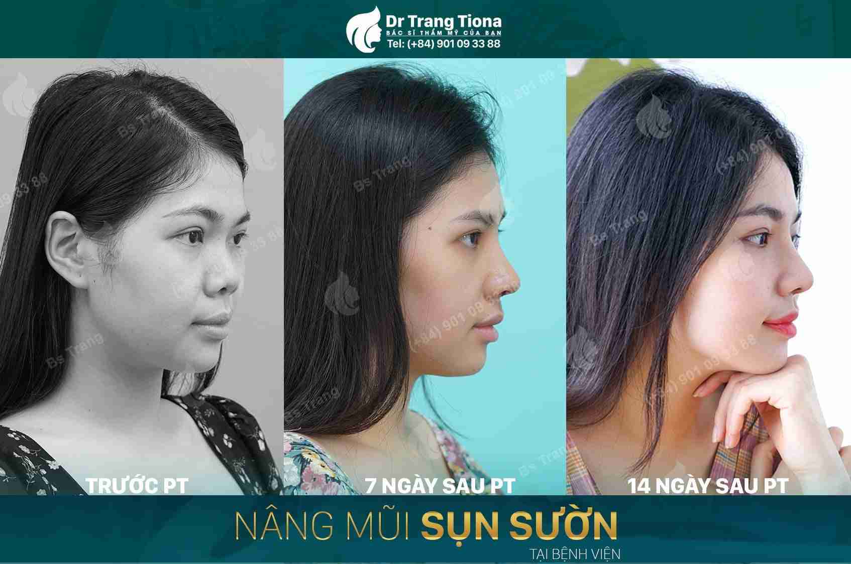 Sở hữu 6 dáng mũi xấu này bạn cần sửa ngay để đổi vận
