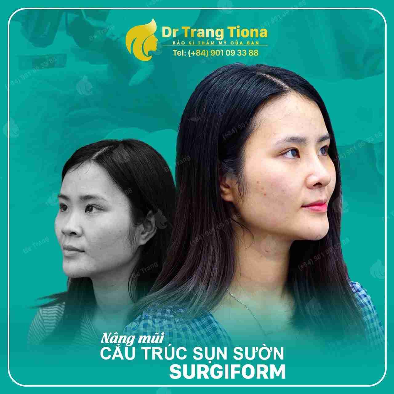 Sở hữu 6 dáng mũi xấu này bạn cần sửa ngay để đổi vận