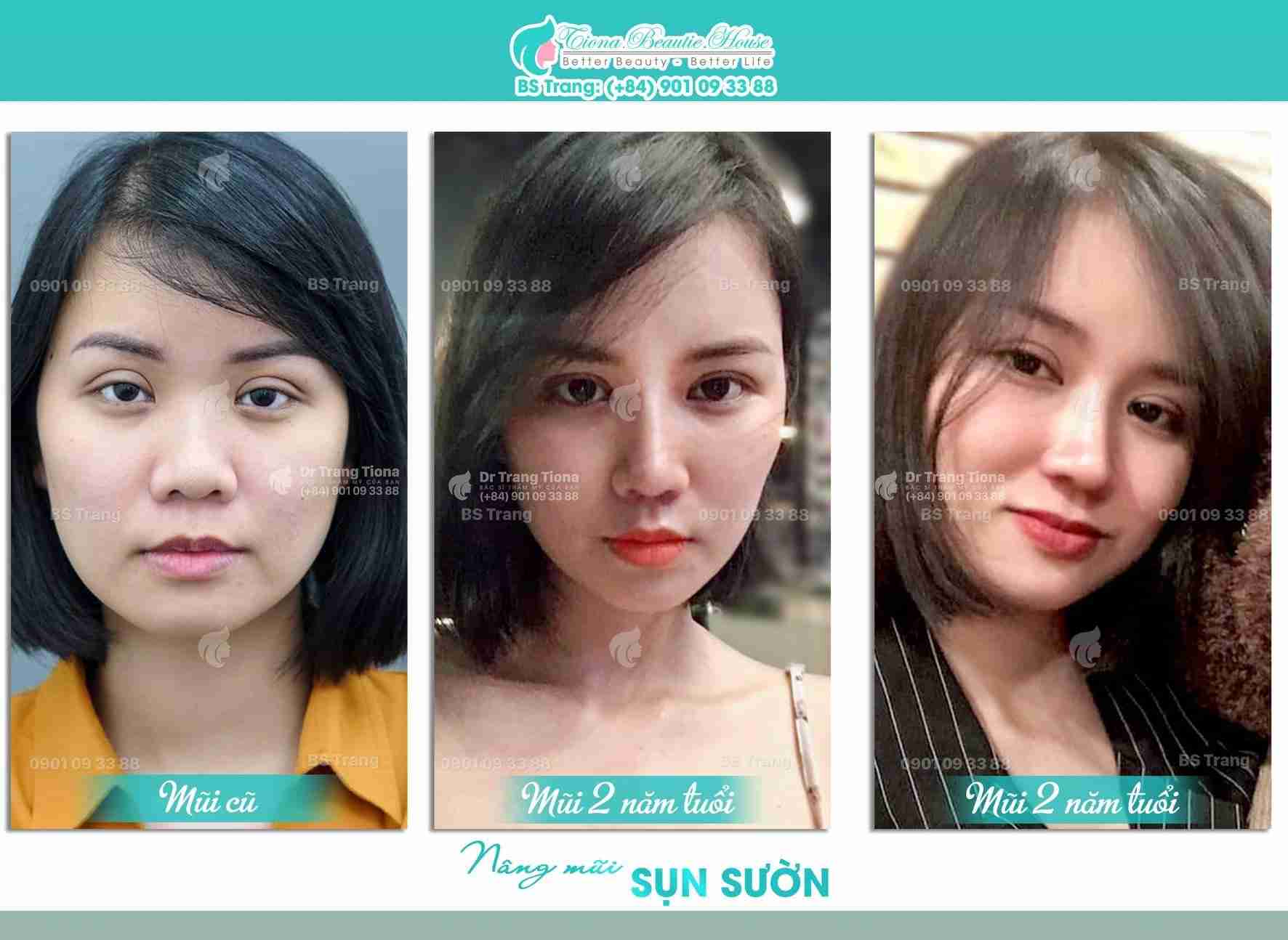 Sở hữu 6 dáng mũi xấu này bạn cần sửa ngay để đổi vận